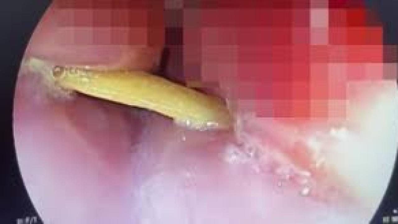 Boğazına saplanan 5 santimlik kemik öldürüyordu
